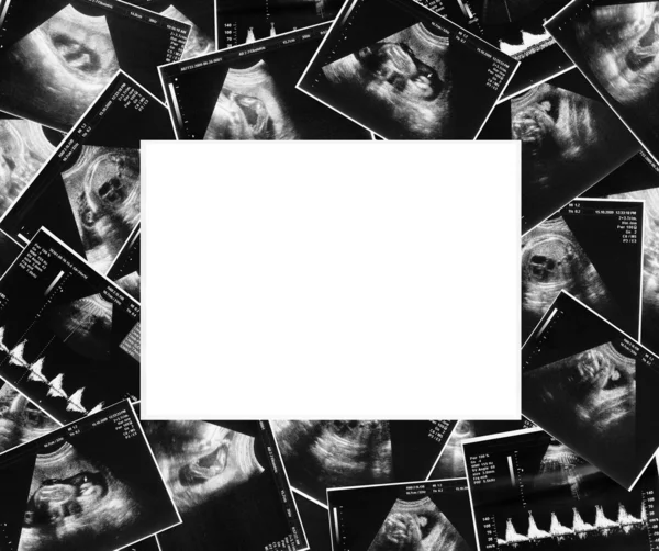Baby op echografie afbeelding — Stockfoto