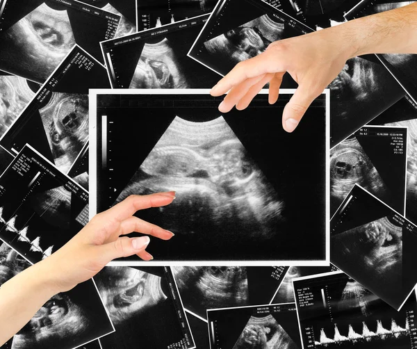 Baby på ultraljud bild — Stockfoto