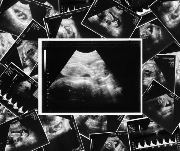 Bebê em uma imagem de ultrassom — Fotografia de Stock
