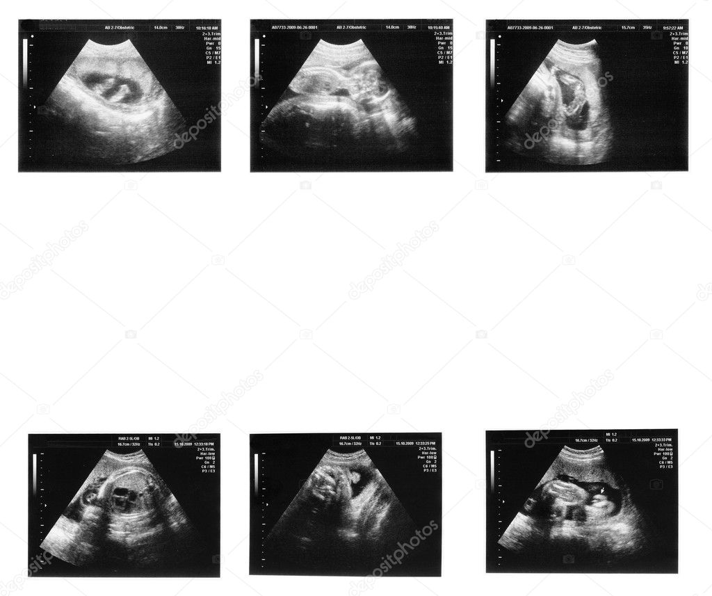 Baby on ultrasound image