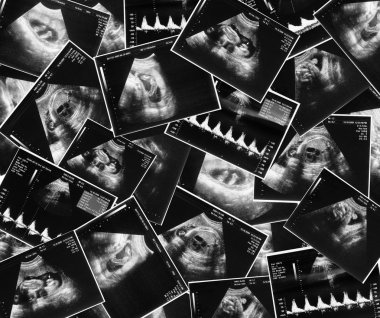 Bebeğin ultrason görüntüsü