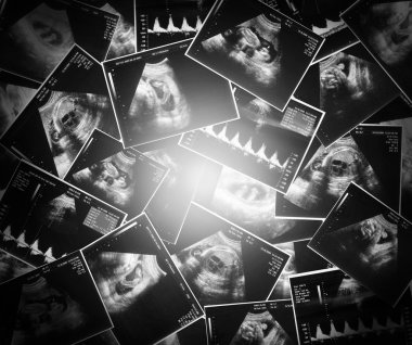 Bebeğin ultrason görüntüsü
