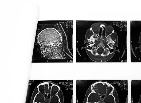 Röntgenfilm av hjärnans datortomografi — Stockfoto