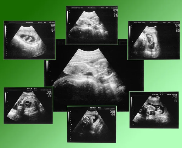 Dítě v obrázek ultrazvuk — Stock fotografie