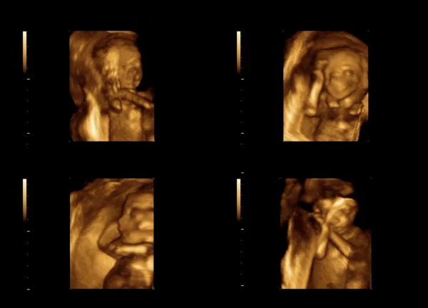 Criança na imagem ultra-som — Fotografia de Stock