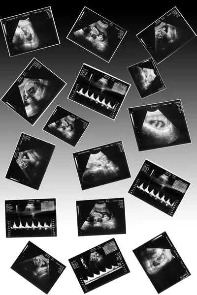 Baby på ett ultraljud bild — Stockfoto