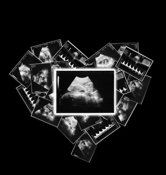 Baby op een echografie afbeelding — Stockfoto