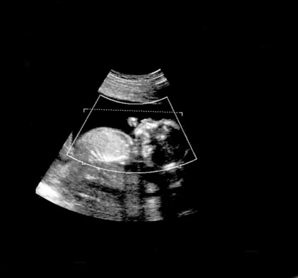 Baby on an ultrasound image — Stock Photo, Image