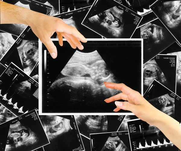 Baby auf einem Ultraschallbild — Stockfoto