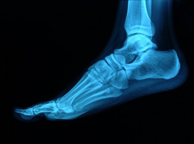 Foot x-ray clipart