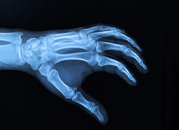 Hand x-ray — Stock Photo, Image