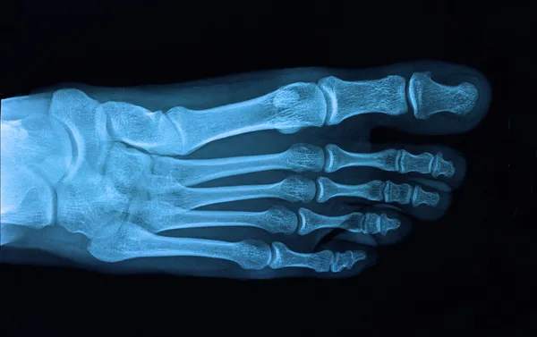 Láb röntgen — Stock Fotó