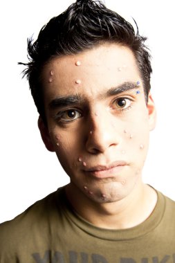 Worried teenager about the pimples he has over his face clipart