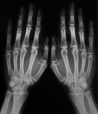 X-ray of hands clipart