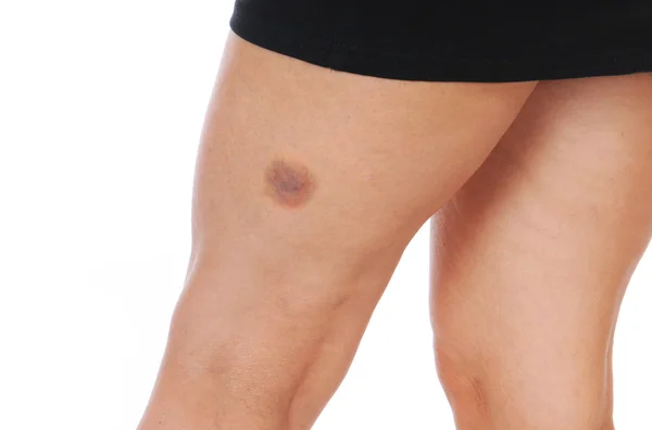 Hematoma — Stock Image Hematoma Stock Photo