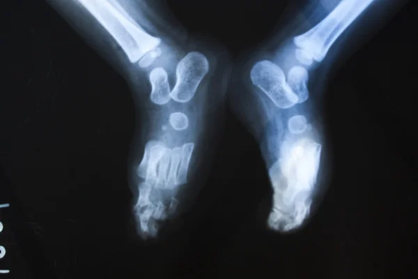 X 射线的骨头 — 图库照片