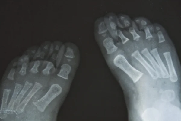 X-Ray Feet — Stock Photo, Image