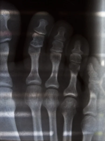 X 射线的手指 — 图库照片