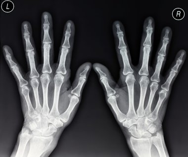 Hands X-ray clipart