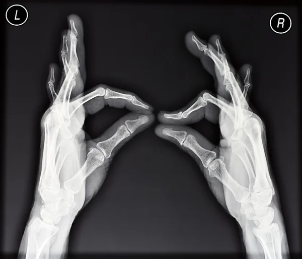 Raio-X das mãos — Fotografia de Stock