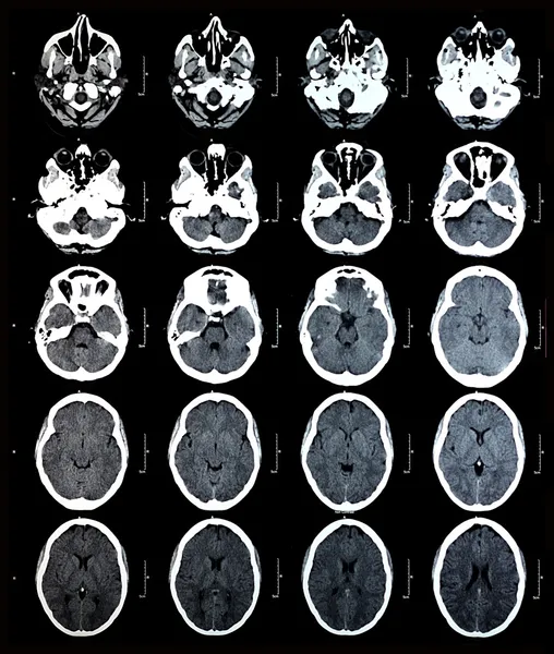 КТ-снимки мозга — стоковое фото