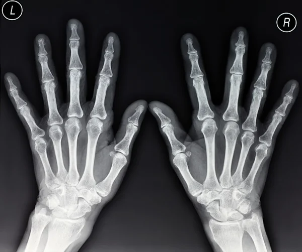 Hände-Röntgen Stockbild