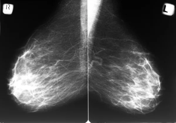 Mammographie lizenzfreie Stockbilder