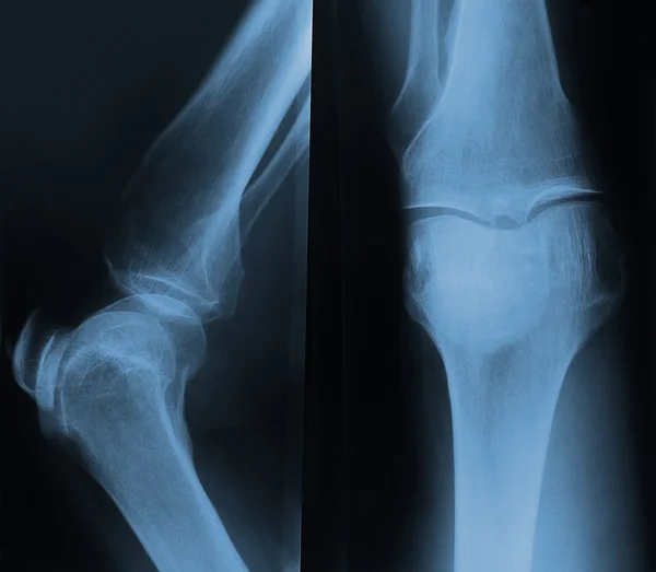 X-ray of the knee. — Stock Photo, Image