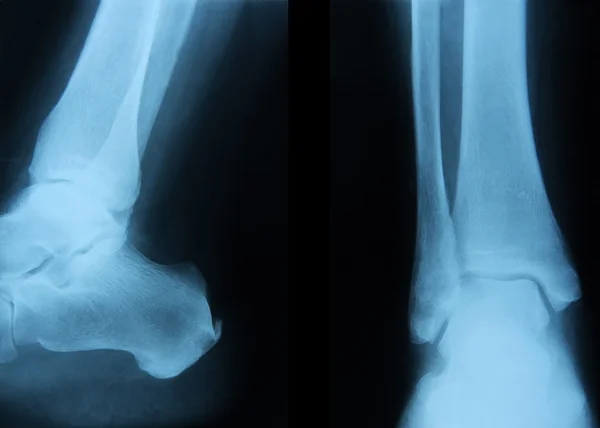 Ankle joint — Stock Photo, Image