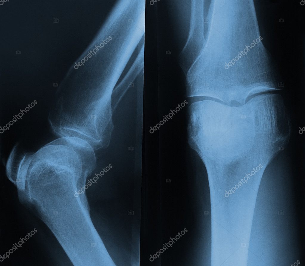 röntgenfoto van de knie — Stockfoto © Shtanzman 11559932