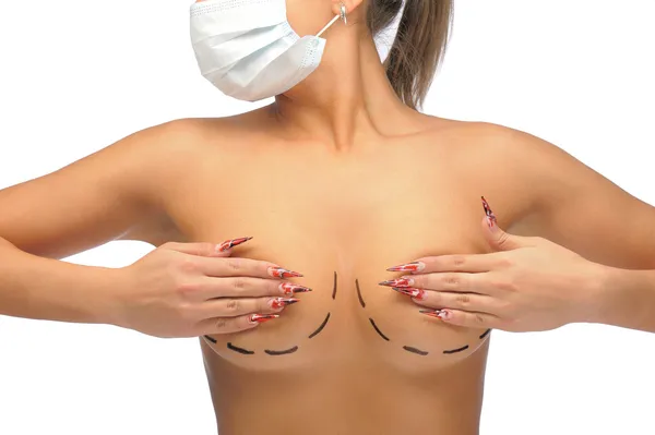 Foto de primer plano de los senos de una mujer caucásica marcada con líneas para la modificación de los senos en la máscara médica — Foto de Stock