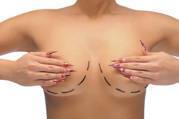 Foto de primer plano de los senos de una mujer caucásica marcada con líneas para la modificación de los senos — Foto de Stock