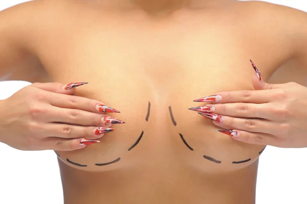 Closeup photo of a Caucasian woman's breasts marked with lines for breast modification — Stock Photo, Image