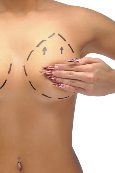 Photo rapprochée des seins d'une femme caucasienne marquée de lignes pour la modification mammaire — Photo