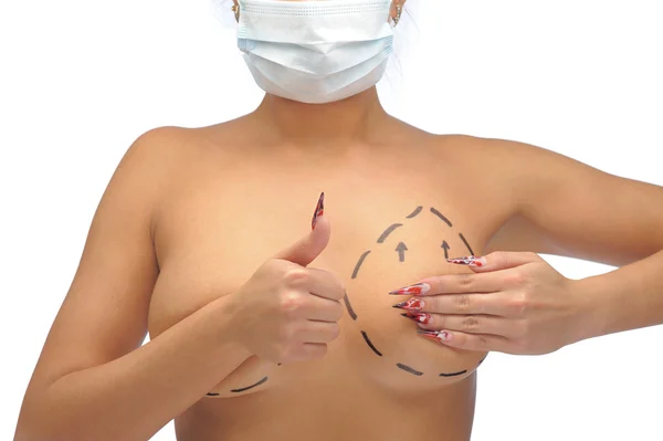 Foto de primer plano de los pechos de una mujer caucásica marcada con líneas para la modificación del pecho con su pulgar grande hacia arriba en máscara médica — Foto de Stock