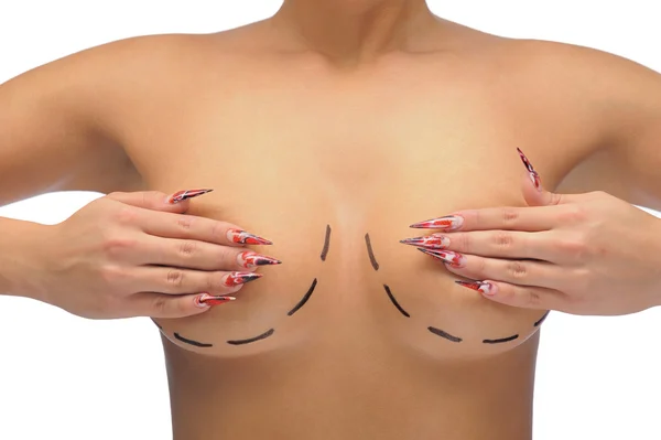 Photo rapprochée des seins d'une femme caucasienne marquée de lignes pour la modification mammaire Photo De Stock