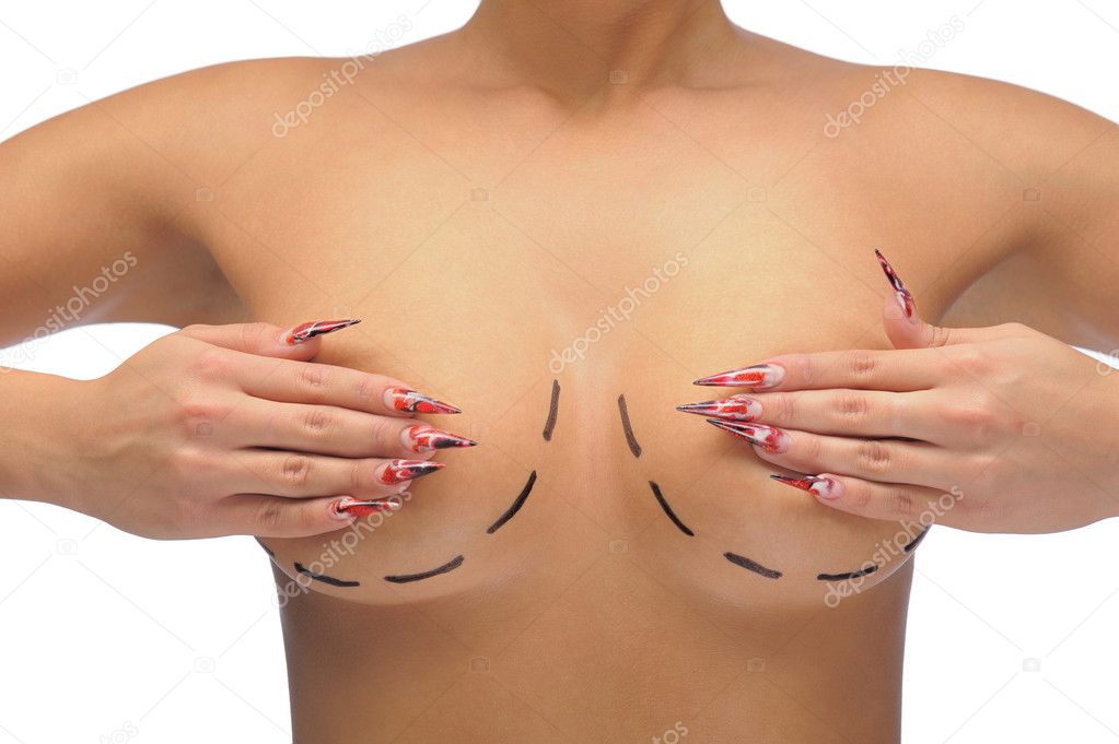 Closeup photo of a Caucasian woman's breasts marked with lines for breast modification