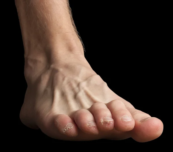 Um pé com a pele quebrada nos dedos dos pés — Fotografia de Stock