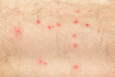 Mosquito spots on human skin clipart