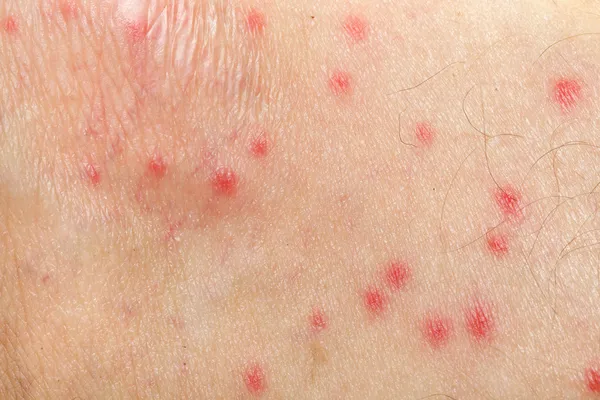 Аллергия на комаров на кожу человека — стоковое фото