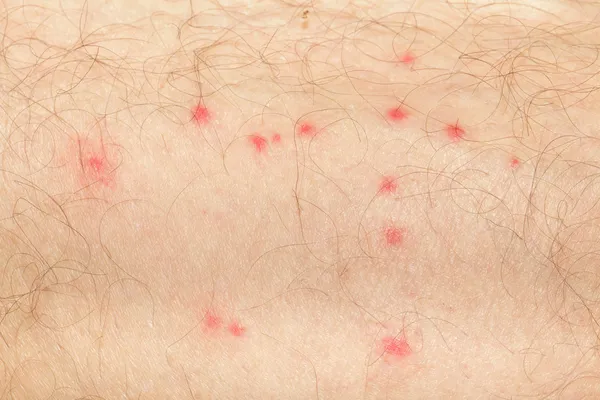 Manchas de mosquitos en la piel humana — Foto de Stock