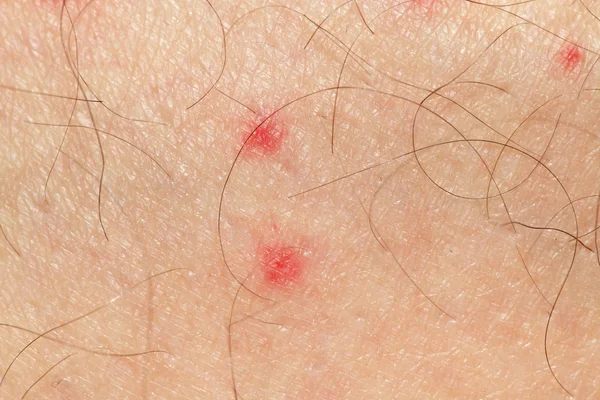 Spots on human skin — Stock Photo, Image