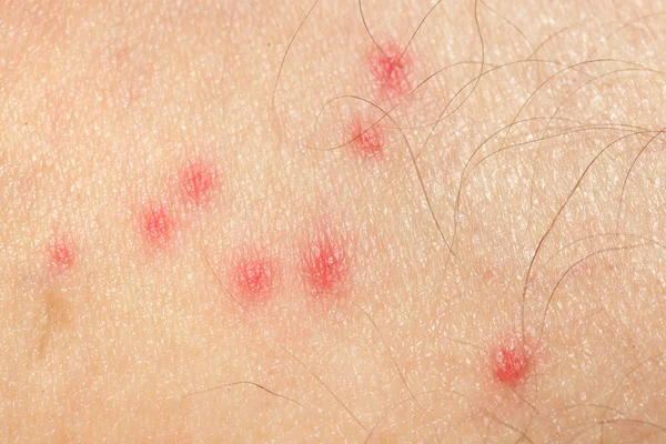 Picadas de mosquito — Fotografia de Stock