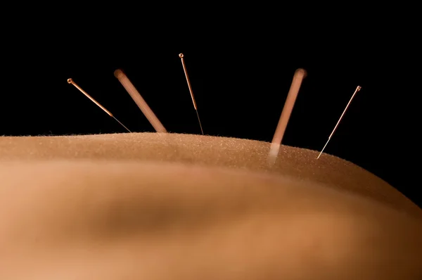 Acupunctuur — Stockfoto