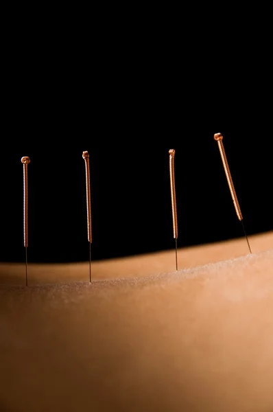 Akupunktura — Stock fotografie