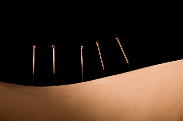 Akupunktura — Zdjęcie stockowe