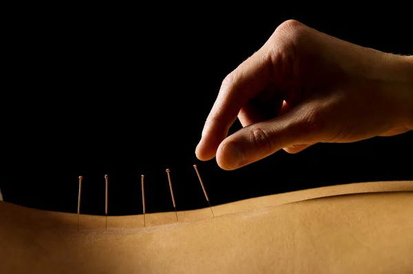 Akupunktura — Zdjęcie stockowe