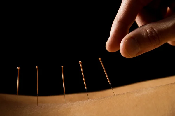 Akupunktur — Stockfoto