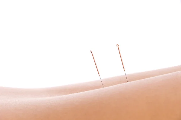 Acupuncture — Photo