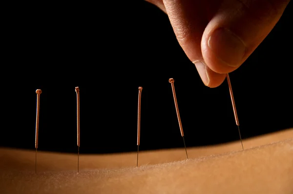 Akupunktura Royalty Free Stock Fotografie
